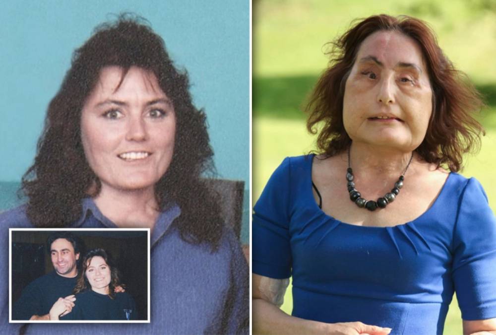 Muere A Los 57 Años La Primera Mujer Que Recibió Un Trasplante De Cara